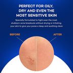 Zocular - ZocuZap Acne Face Wipes - Moisturizing Face Cleansing Wipes for Acne, Makeup Removal, and Exfoliation with Natural Okra Complex for Sensitive, Rosacea Skin - 30/ct