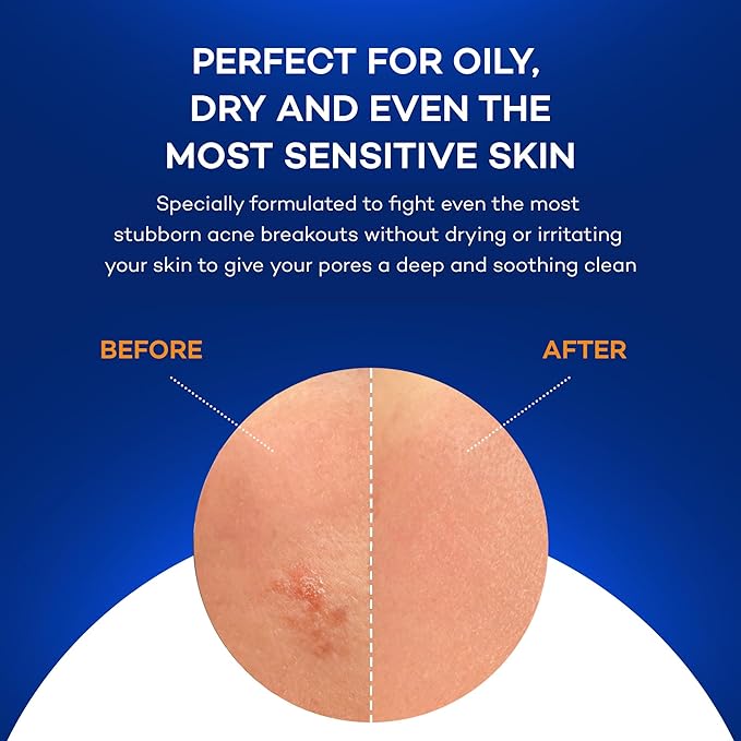 Zocular - ZocuZap Acne Face Wipes - Moisturizing Face Cleansing Wipes for Acne, Makeup Removal, and Exfoliation with Natural Okra Complex for Sensitive, Rosacea Skin - 15/ct